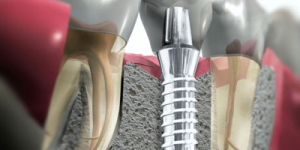 Implantes Dentales