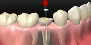 Endodoncia